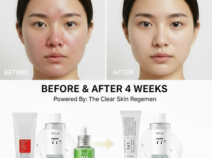 Acne Treatment Set – Clear, Calm & Healthy Skin Routine